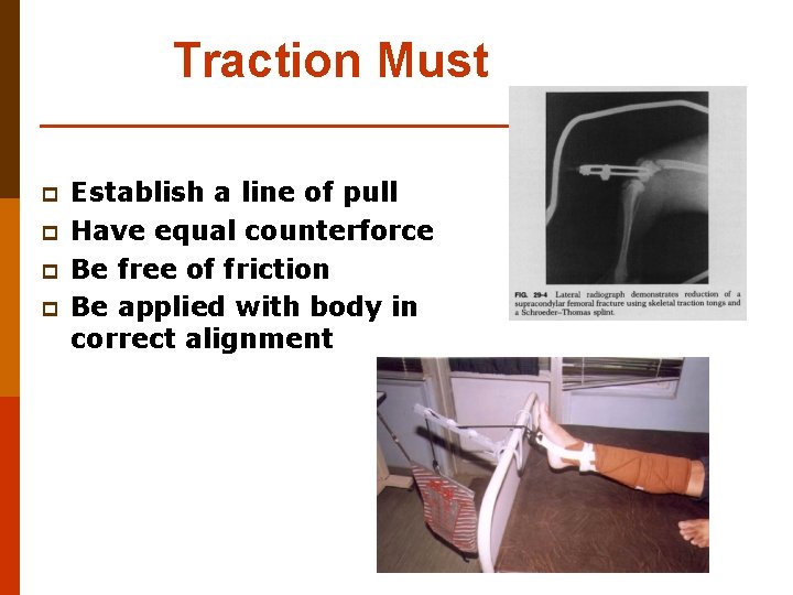 Traction Must p p Establish a line of pull Have equal counterforce Be free