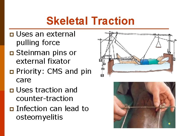 Skeletal Traction Uses an external pulling force p Steinman pins or external fixator p