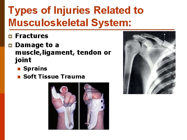 Types of Injuries Related to Musculoskeletal System: p p Fractures Damage to a muscle,