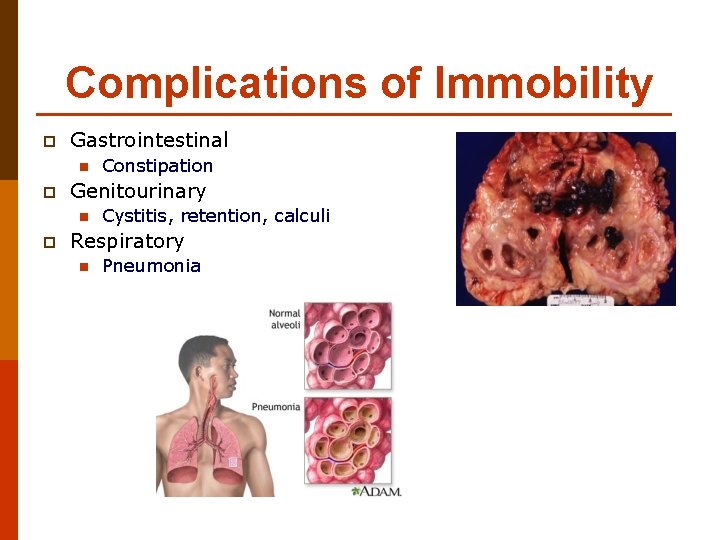 Complications of Immobility p Gastrointestinal n p Genitourinary n p Constipation Cystitis, retention, calculi