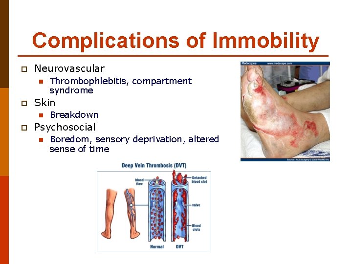 Complications of Immobility p Neurovascular n p Skin n p Thrombophlebitis, compartment syndrome Breakdown