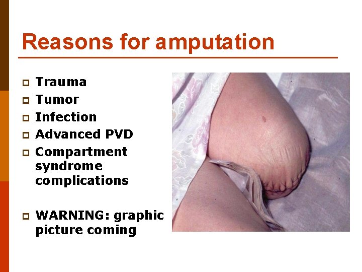 Reasons for amputation p p p Trauma Tumor Infection Advanced PVD Compartment syndrome complications