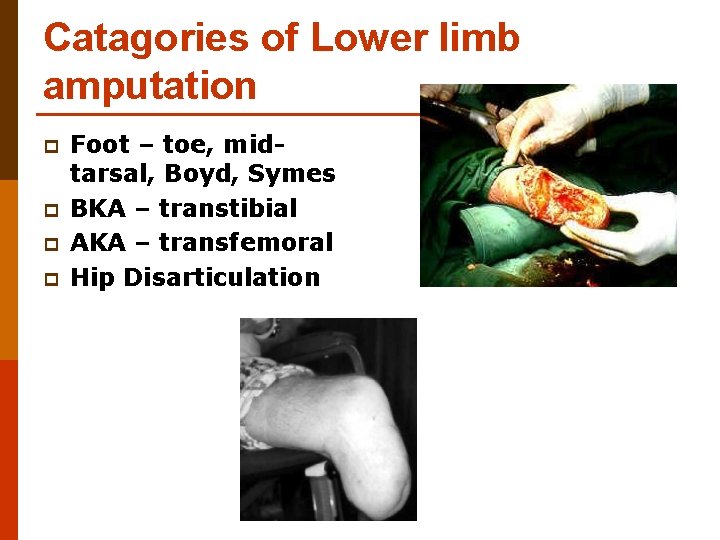 Catagories of Lower limb amputation p p Foot – toe, midtarsal, Boyd, Symes BKA