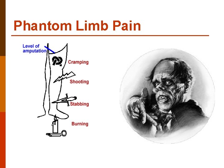 Phantom Limb Pain 