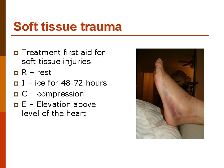 Soft tissue trauma p p p Treatment first aid for soft tissue injuries R