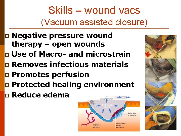 Skills – wound vacs (Vacuum assisted closure) Negative pressure wound therapy – open wounds