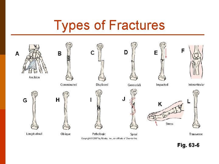 Types of Fractures Fig. 63 -6 