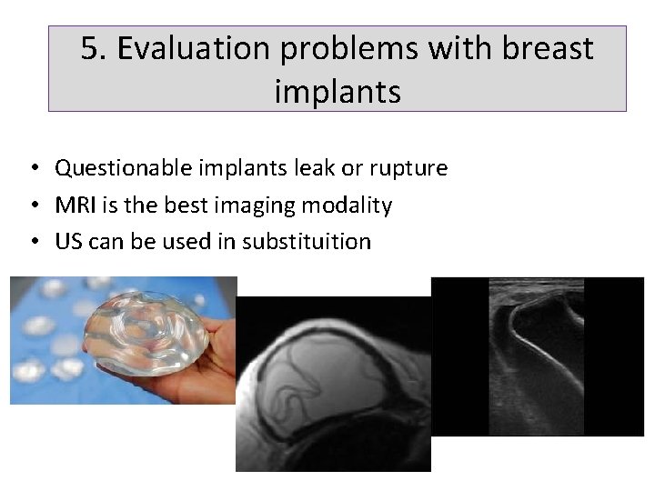 5. Evaluation problems with breast implants • Questionable implants leak or rupture • MRI