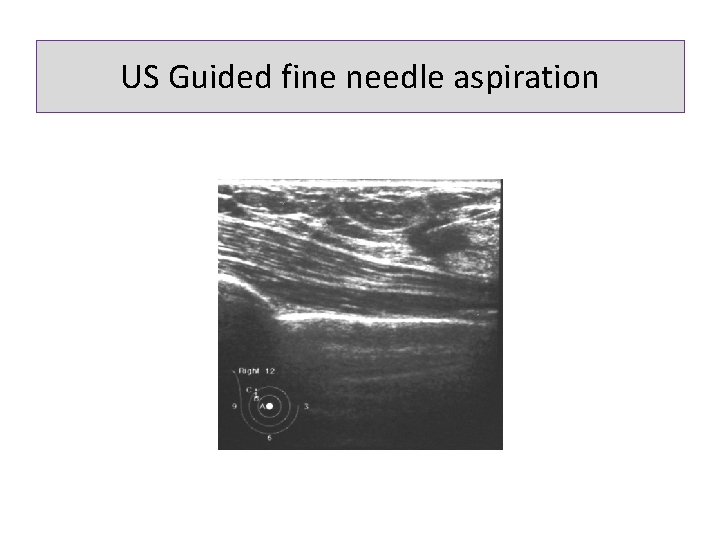 US Guided fine needle aspiration 
