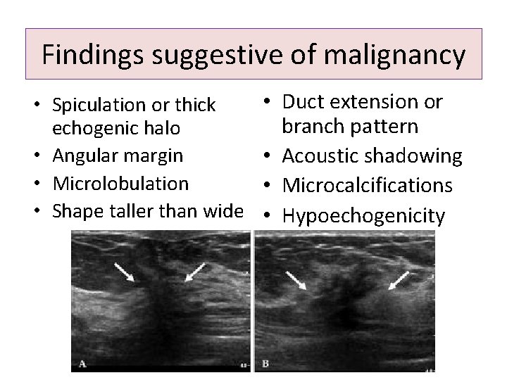 Findings suggestive of malignancy • Spiculation or thick echogenic halo • Angular margin •