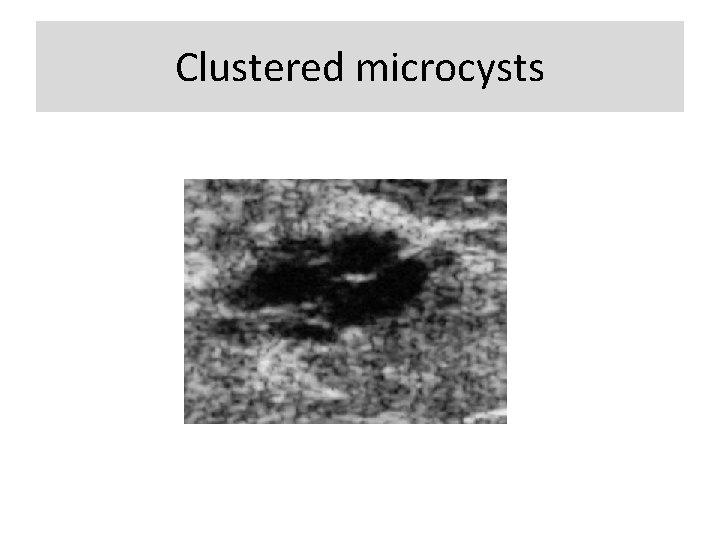 Clustered microcysts 