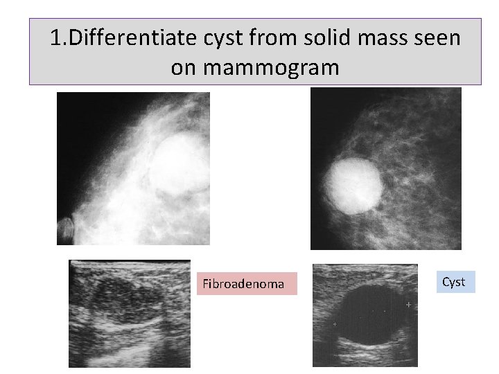 1. Differentiate cyst from solid mass seen on mammogram Fibroadenoma Cyst 