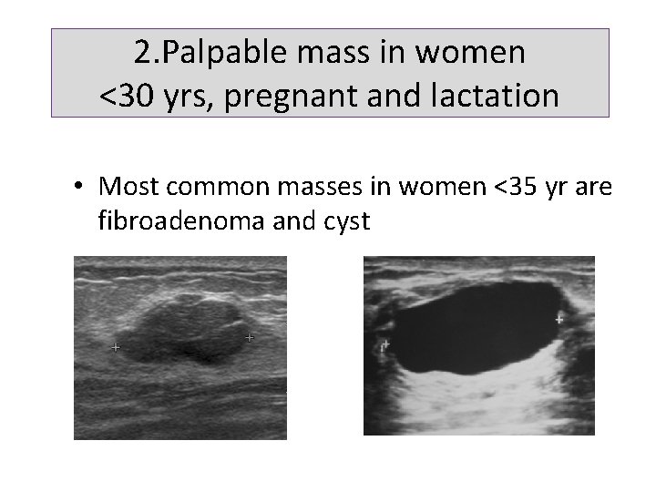 2. Palpable mass in women <30 yrs, pregnant and lactation • Most common masses