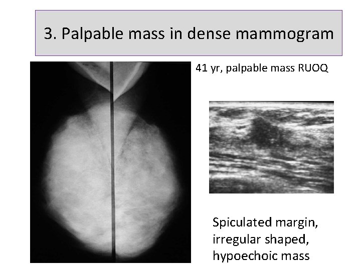 3. Palpable mass in dense mammogram 41 yr, palpable mass RUOQ Spiculated margin, irregular