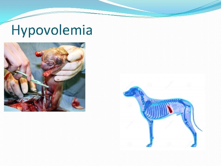 Hypovolemia 