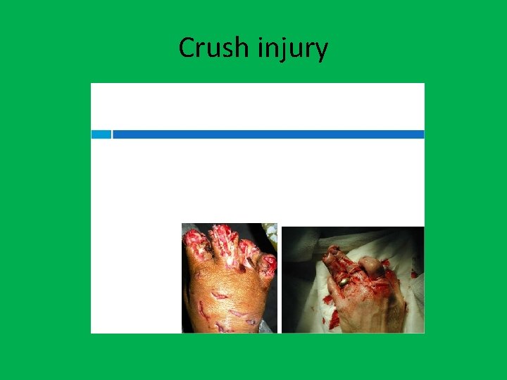 Crush injury 