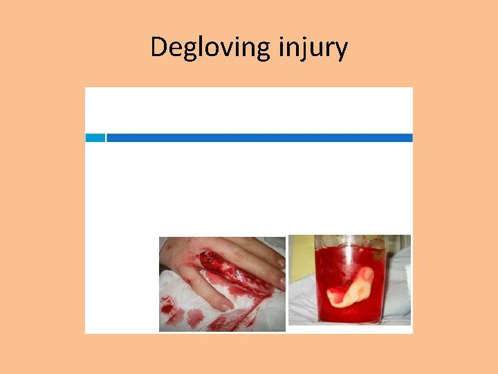 Degloving injury 