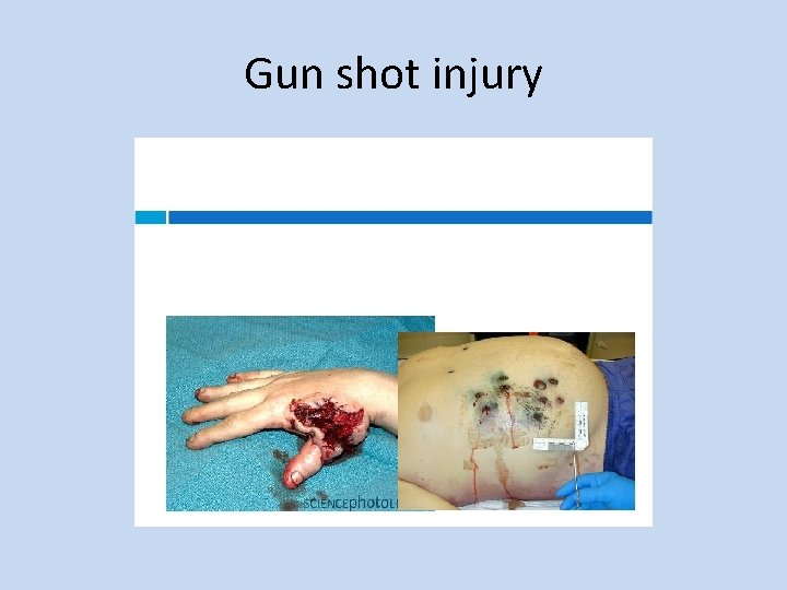 Gun shot injury 