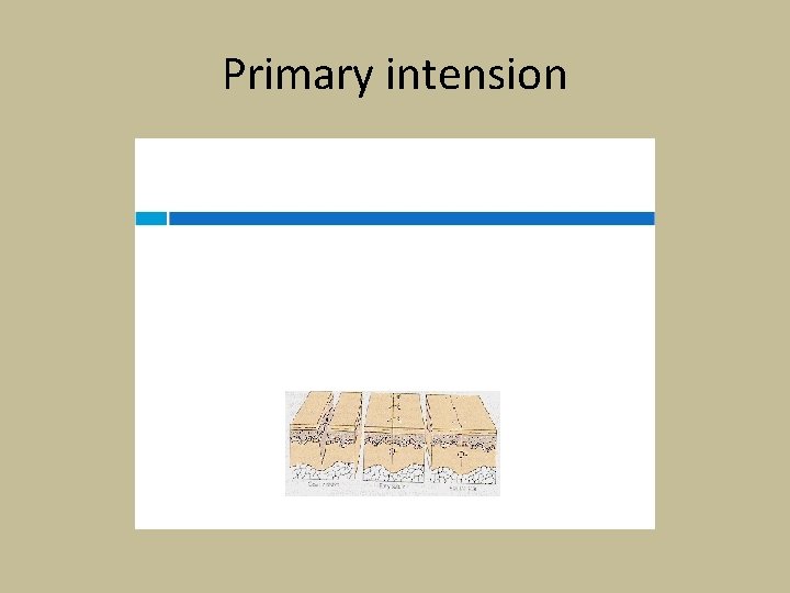 Primary intension 