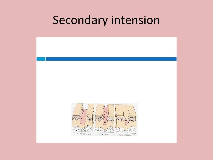 Secondary intension 