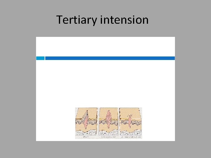 Tertiary intension 