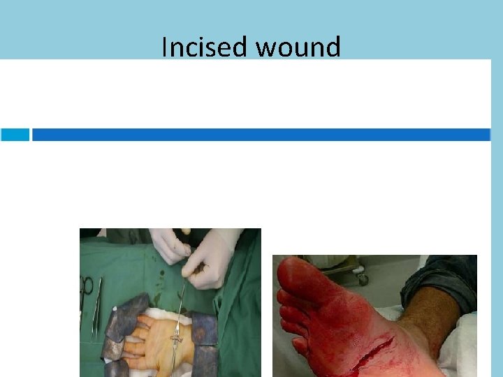 Incised wound 