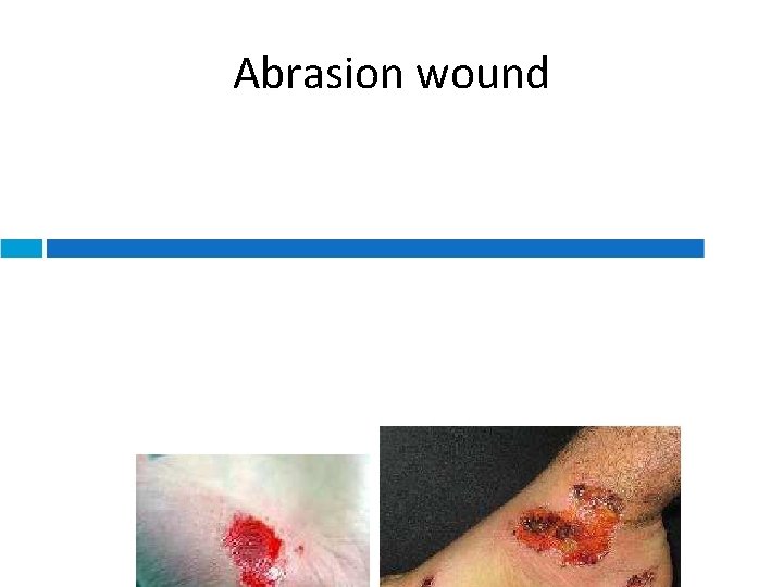 Abrasion wound 