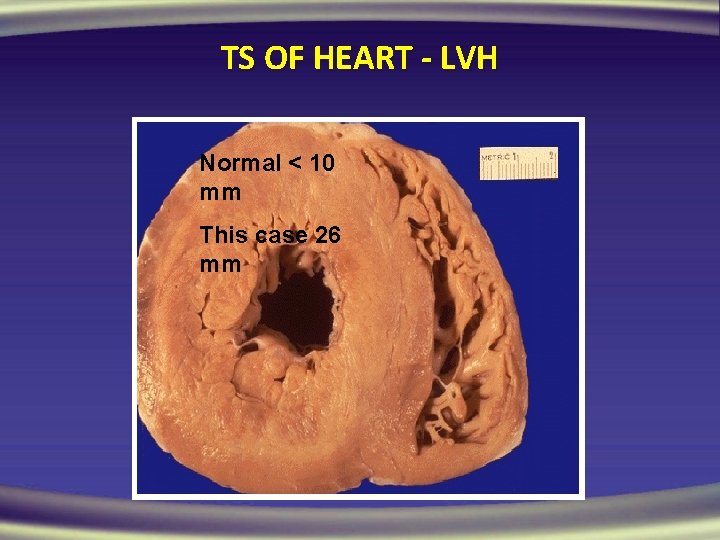 TS OF HEART - LVH Normal < 10 mm This case 26 mm 