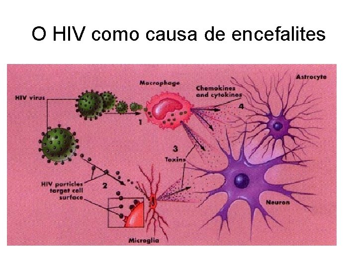 O HIV como causa de encefalites 