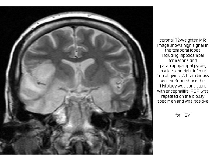 coronal T 2 -weighted MR image shows high signal in the temporal lobes including