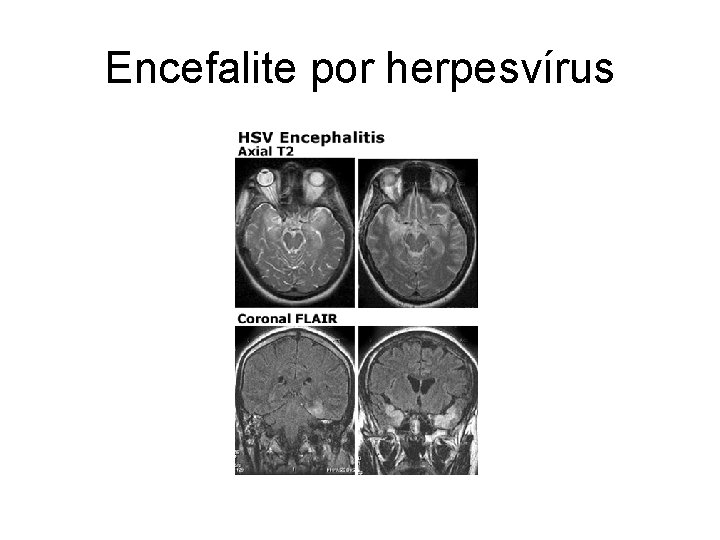 Encefalite por herpesvírus 