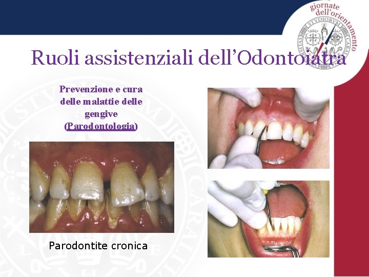 Ruoli assistenziali dell’Odontoiatra Prevenzione e cura delle malattie delle gengive (Parodontologia) Parodontite cronica 