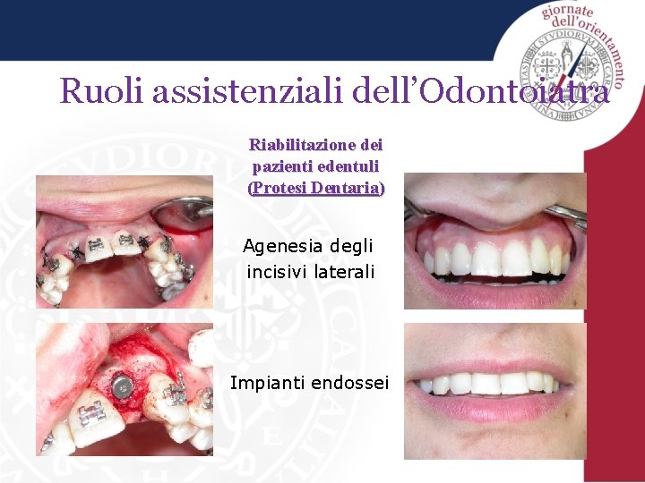 Ruoli assistenziali dell’Odontoiatra Riabilitazione dei pazienti edentuli (Protesi Dentaria) Agenesia degli incisivi laterali Impianti