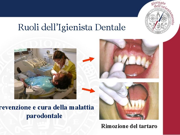Ruoli dell’Igienista Dentale revenzione e cura della malattia parodontale Rimozione del tartaro 