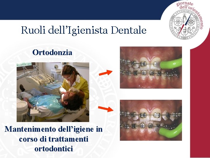 Ruoli dell’Igienista Dentale Ortodonzia Mantenimento dell’igiene in corso di trattamenti ortodontici 