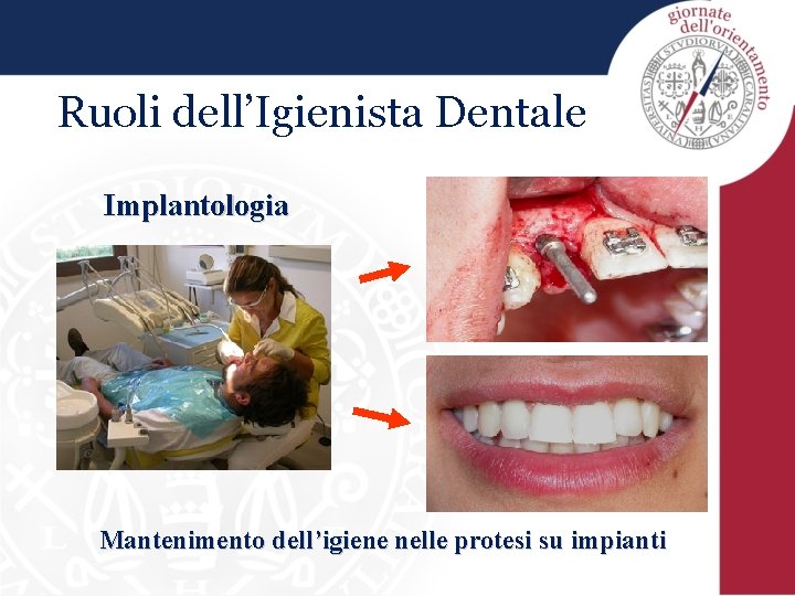 Ruoli dell’Igienista Dentale Implantologia Mantenimento dell’igiene nelle protesi su impianti 