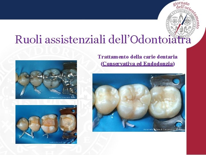 Ruoli assistenziali dell’Odontoiatra Trattamento della carie dentaria (Conservativa ed Endodonzia) 