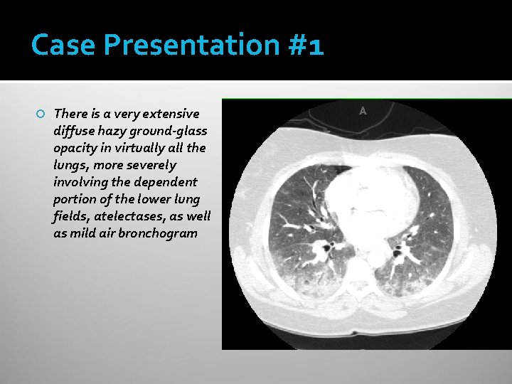 Case Presentation #1 There is a very extensive diffuse hazy ground-glass opacity in virtually