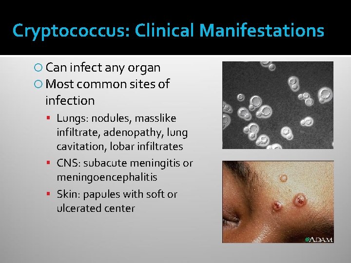 Cryptococcus: Clinical Manifestations Can infect any organ Most common sites of infection Lungs: nodules,