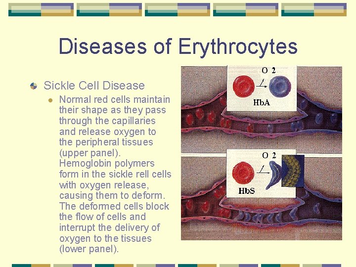 Diseases of Erythrocytes Sickle Cell Disease l Normal red cells maintain their shape as