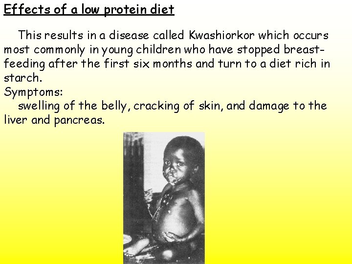 Effects of a low protein diet This results in a disease called Kwashiorkor which