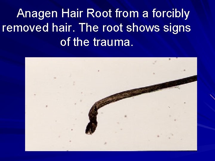 Anagen Hair Root from a forcibly removed hair. The root shows signs of the