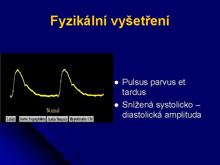 Fyzikální vyšetření l l Pulsus parvus et tardus Snížená systolicko – diastolická amplituda 
