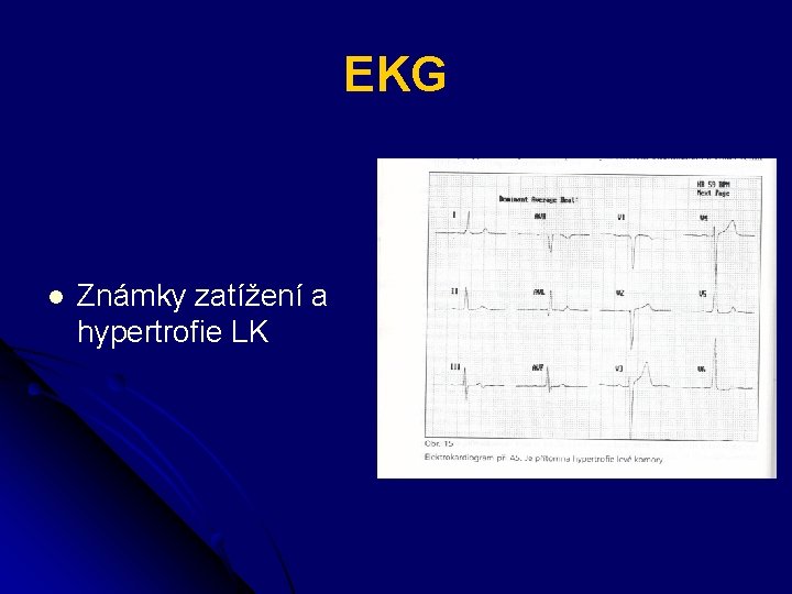 EKG l Známky zatížení a hypertrofie LK 