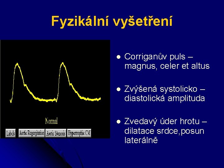 Fyzikální vyšetření l Corriganův puls – magnus, celer et altus l Zvýšená systolicko –