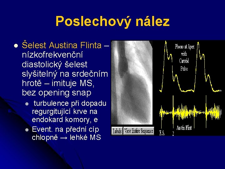 Poslechový nález l Šelest Austina Flinta – nízkofrekvenční diastolický šelest slyšitelný na srdečním hrotě