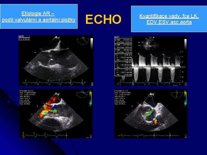 Etiologie AR – podíl valvulární a aortální složky ECHO Kvantifikace vady, fce LK, EDV,