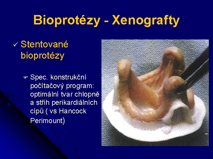 Bioprotézy - Xenografty ü Stentované bioprotézy F Spec. konstrukční počítačový program: optimální tvar chlopně