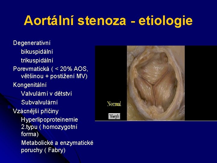 Aortální stenoza - etiologie Degenerativní bikuspidální trikuspidální Porevmatická ( < 20% AOS, většinou +