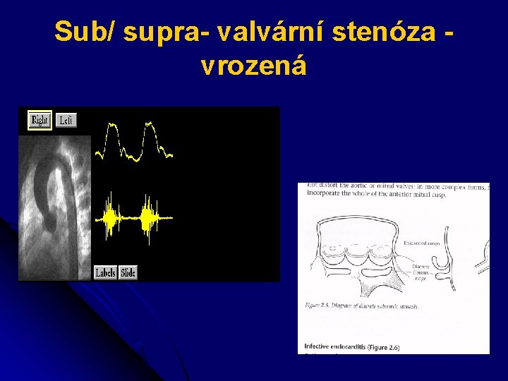 Sub/ supra- valvární stenóza vrozená 